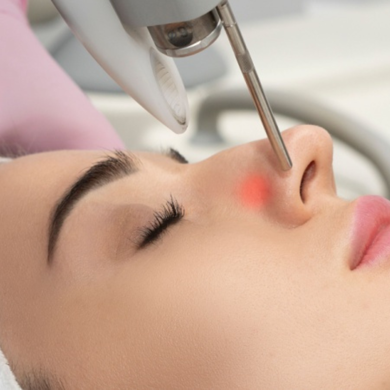 Laserowe zamykanie naczynek Fotona Kraków – redukcja rumienia i pajączków